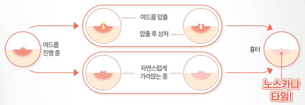 노스카나겔을 언제 사용해야 하는지 보여주는 이미지